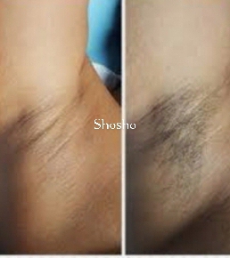Underarm before and after waxing at Shosho Beauty Spa