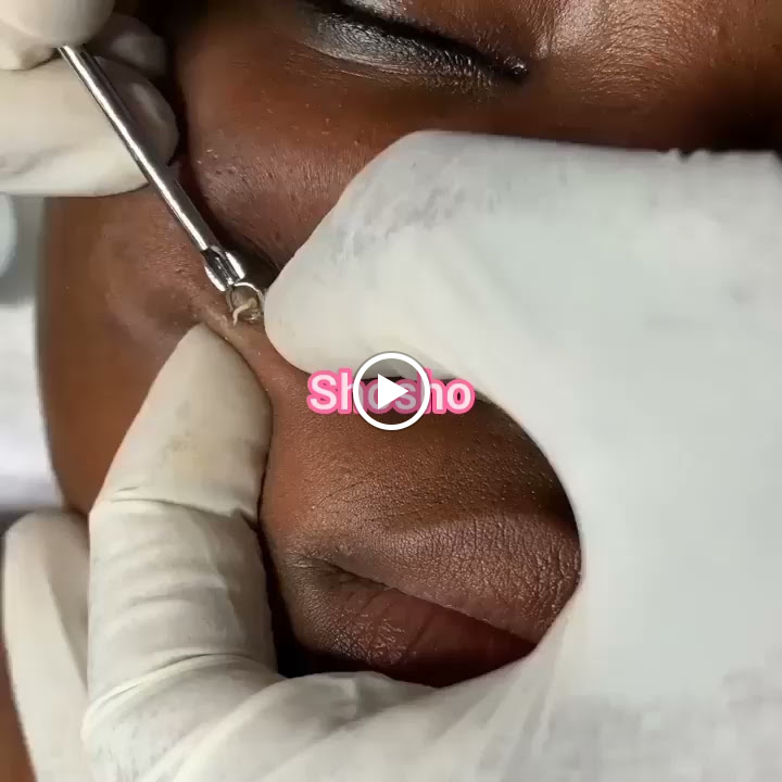 Therapist performing facial extraction with a professional tool