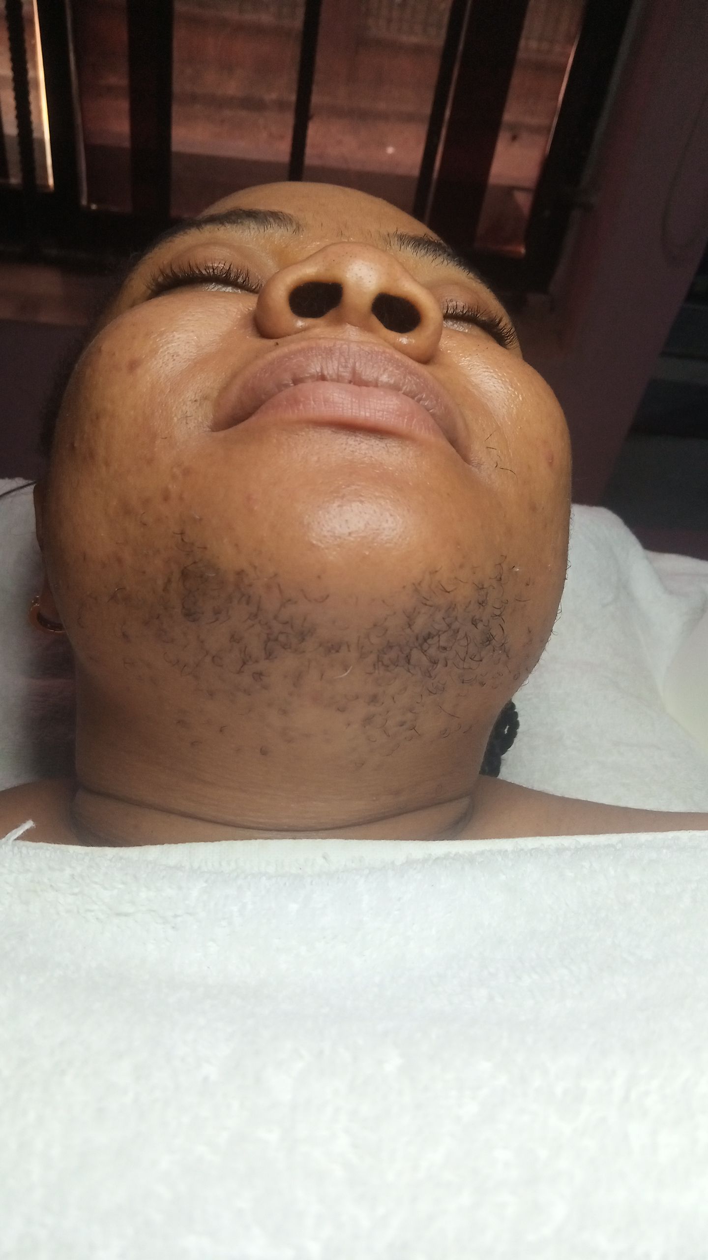 Smooth chin and jawline after treatment at Shosho