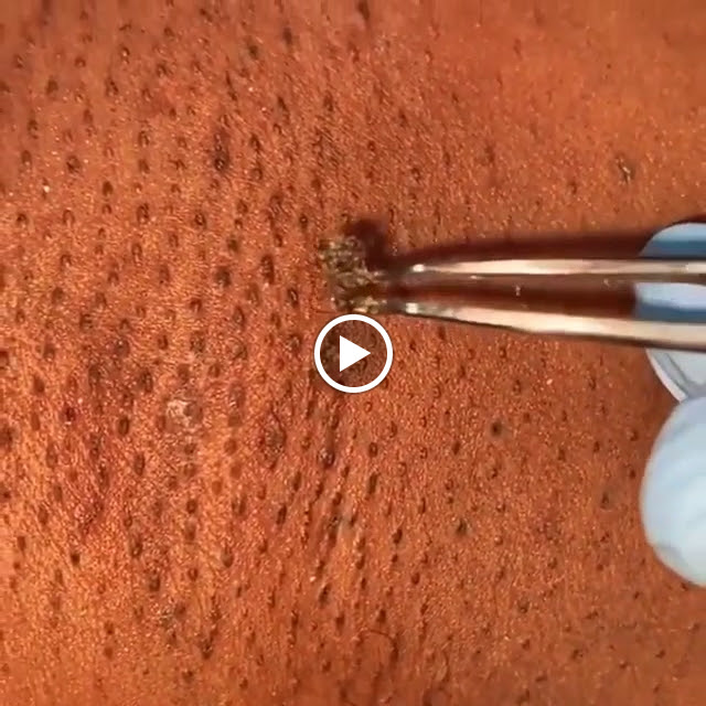 Ingrown hair removal with tweezers