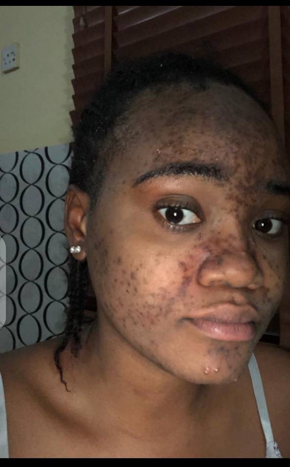 Acne prone skin before treatment