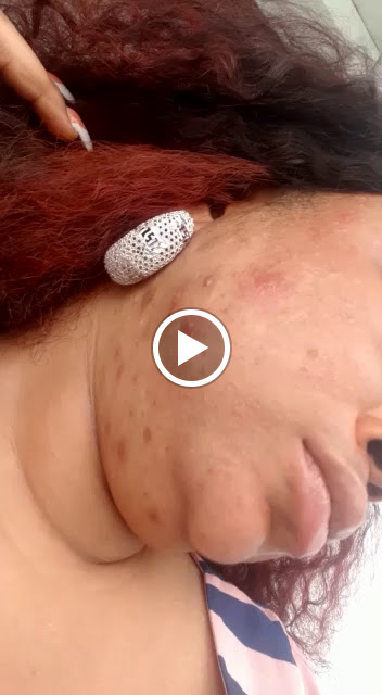 Extraction on the neck during an acne treatment