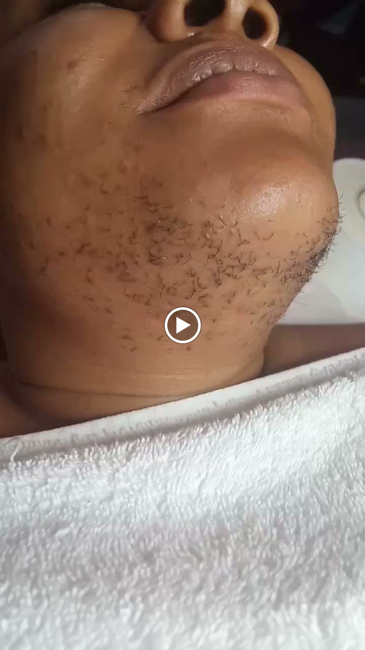 Chin after waxing at Shosho Beauty Spa