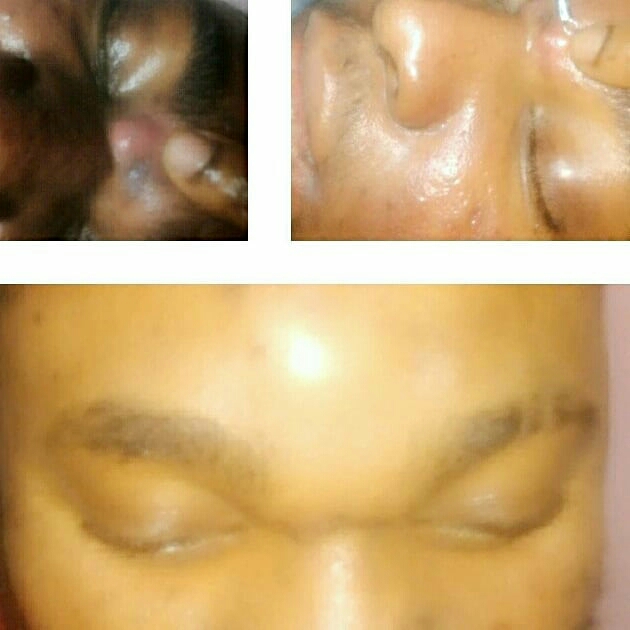 Face before and after a Shosho skin treatment