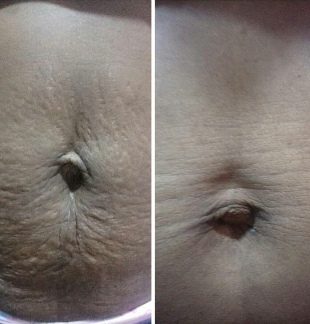 Stretch marks on the stomach before treatment