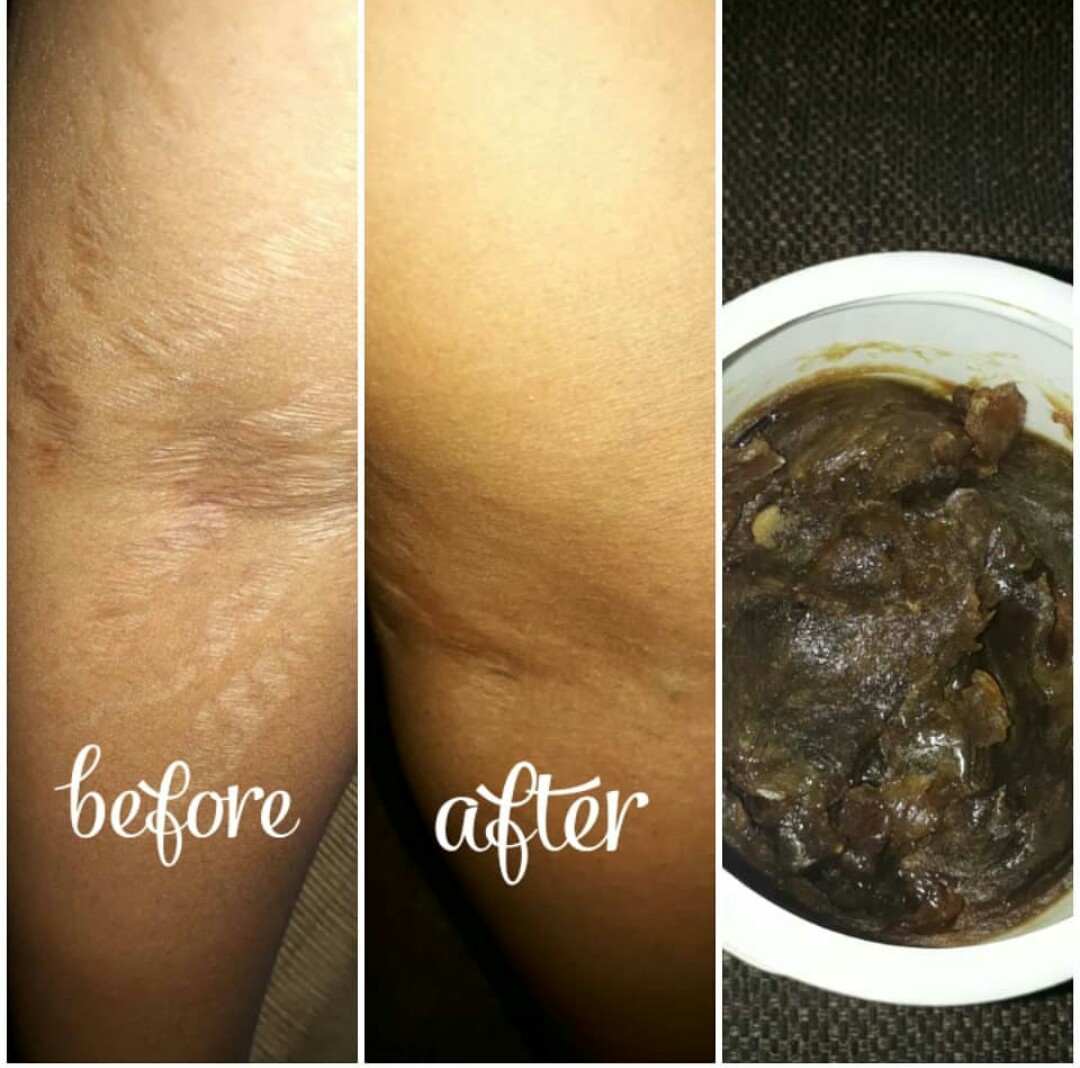 Stretch mark soap before and after results